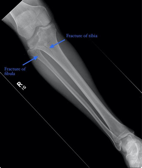 Fractures Of The Tibia And Fibula Most Common In Athletes Especially