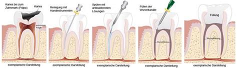 Ablauf Einer Wurzelkanalbehandlung Zahnarzt Praxis Ludwigshafen Dr