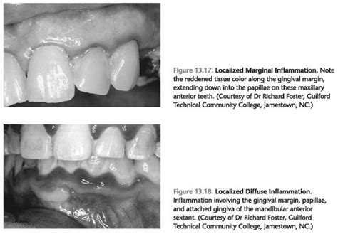 Extent And Distribution Of Inflammation Foundations Of Periodontics