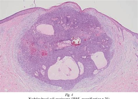 Histological Types Of Basal Cell Carcinoma Semantic Scholar