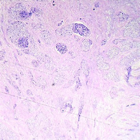 Photomicrograph Of A Case Of Mucoepidermoid Carcinoma Hande Stain ×100