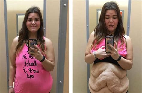 This Is My Life Woman Shares Reality Of Excess Skin After Incredible Weight Loss Goodtoknow