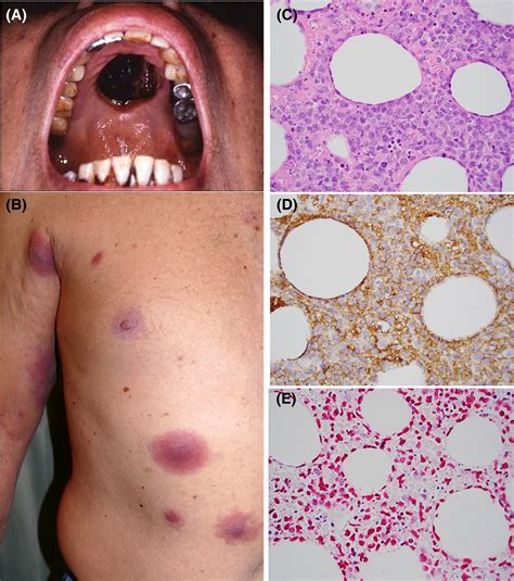 Cutaneous T Cell Lymphoma Survival