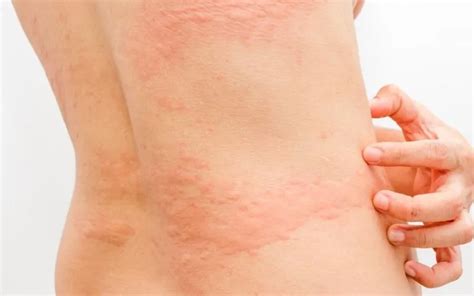 Can Cancer Cause Hives And Itching A Comprehensive Guide