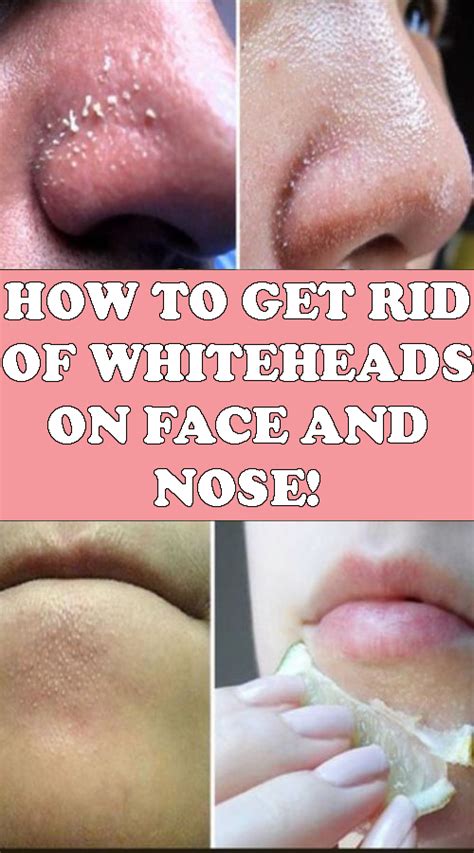 Whiteheads Removal