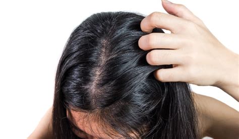 Oily Scalp Why You Have It And How To Prevent It Nizoral