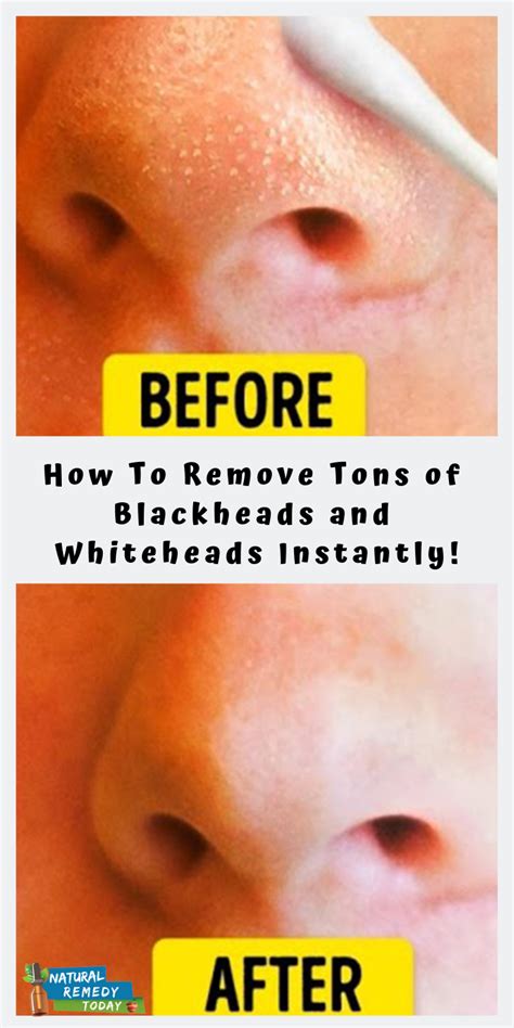 How To Remove Tons Of Blackheads And Whiteheads Instantly Acne On