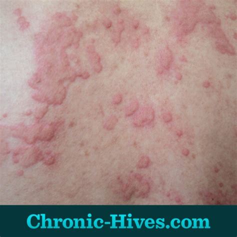 What Are Symptoms Of Chronic Hives