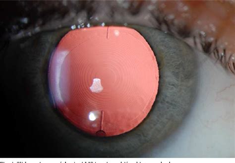Figure 2 From Toric Intraocular Lenses In Cataract Surgery Semantic