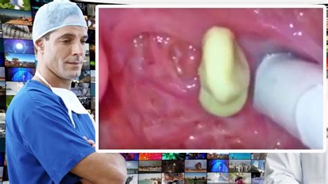 Tonsil Stone Removal Tools Tonsillolith Documentary Youtube