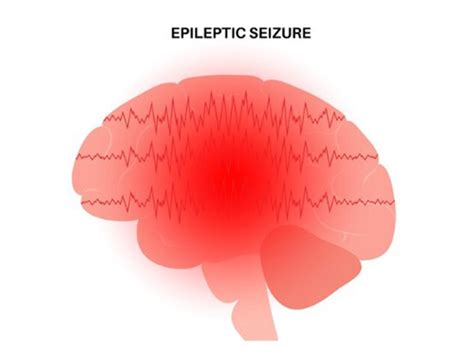 What To Do If Someone Is Having A Seizure Sancheti Hospital