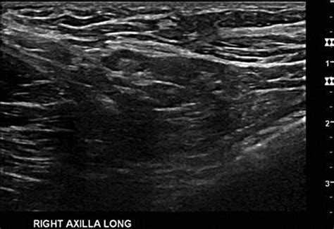 Swollen Lymph Node Armpit Ultrasound