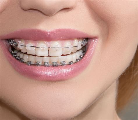 Cheap Invisible Braces Cost Of Invisible Braces