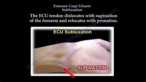 Extensor Carpi Ulnaris Subluxation Everything You Need To Know Dr