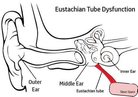 Eustachian Tube Dysfunction Otoscopy