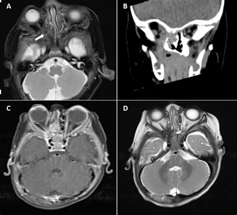 A Axial Mri Showing Soft Tissue Lesion Centred Upon Posterior Ethmoid