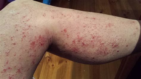 Itchy Rash On Legs What Causes Rashes On Skin Of Legs