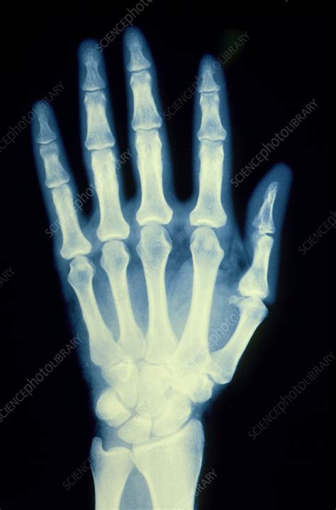X Ray Of A Healthy Human Hand Stock Image P1160247 Science Photo