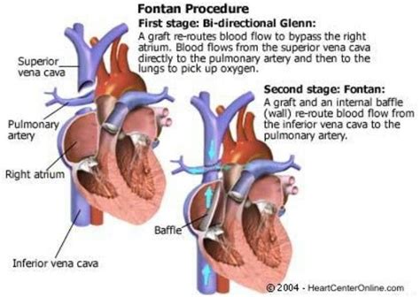 The Fontan The Third In The Series Of Hlhs Surgeries Heart Surgery