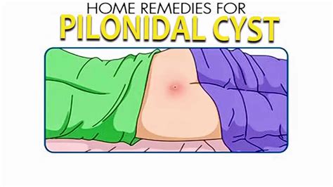 Kyste Pilonidal Causes Symptomes Prevention Et Traitement Maladies