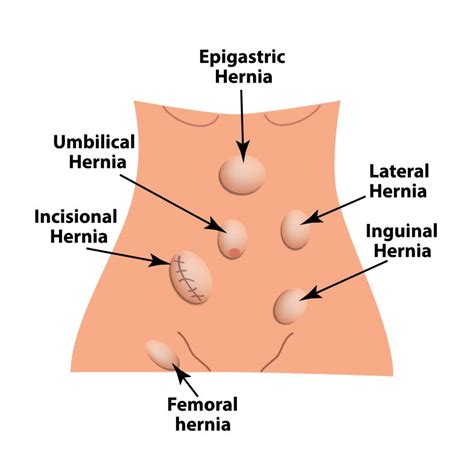 External Abdominal Wall Hernias Abdominal Hernia Abdominal Anatomy My