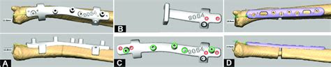 Modes Of The A Drilling And Guide Wire Guide B Cuttingosteotomy