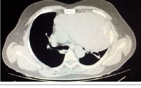 Figure 1 From Malignant Peripheral Nerve Sheath Tumor Of The Anterior