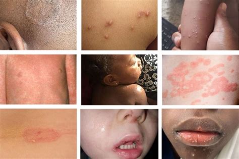 Rashes And Spots Pictures In Toddlers Children And Babies Nhs Doctor