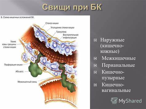Диета При Свище Прямой Кишки — Похудение Диета Правильное Питание Картинка - Диета При Свище Прямой Кишки — Похудение Диета Правильное Питание