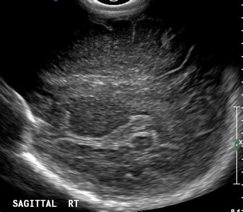 Normal Neonatal Head Ultrasound