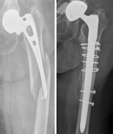 Periprosthetic Femoral Fracture After A Fall Vancouver Type B2