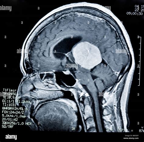 Sagittal Mri Of Brain With Large Brain Tumorcancer Stock Photo Alamy