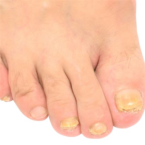 I Think I Have Toenail Fungus Columbus Foot And Ankle