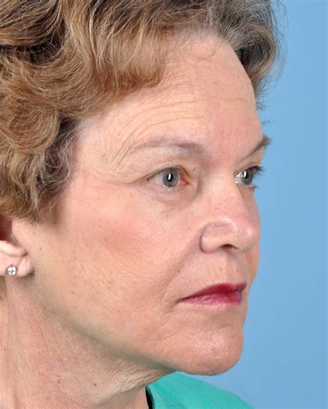 Facelift Before And After Photos By Thomas Hubbard Md Virginia Beach