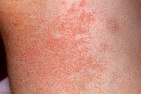 Types Of Heat Rash Heat Rash Types Of Skin Rashes Rashes Images