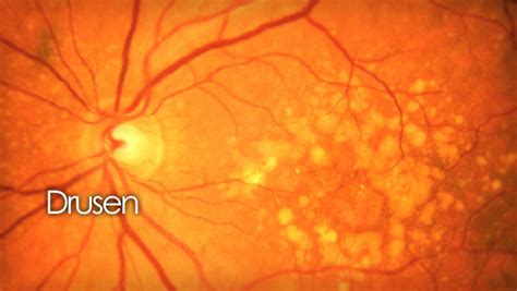 Drusen Small Deposits In The Retina Associated With Macular Degeneration