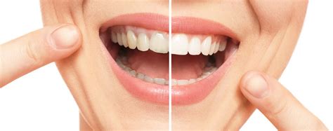 106413 Best Teeth Whitening Images Stock Photos And Vectors Adobe Stock