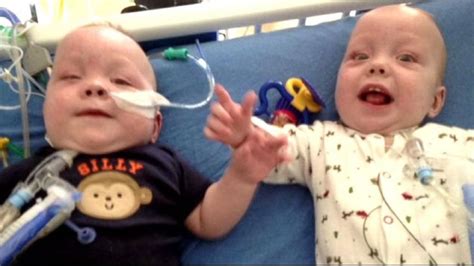 Video Conjoined Twins Separated After 9 Hour Surgery Conjoined Twins