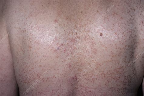 Pityriasis Lichenoides Chronica Stock Image C0517107 Science