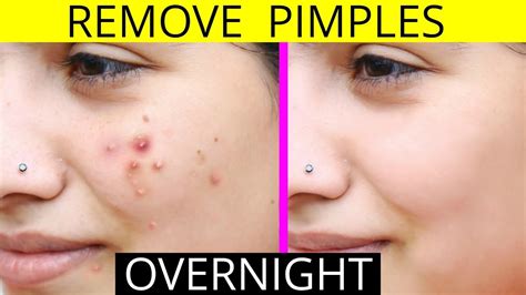 How To Lose A Pimple Overnight Internaljapan9