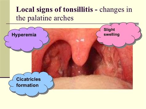Chronic Tonsillitis