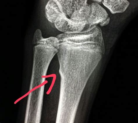 Xray Of The Wrist In A Child With Pain After Fall