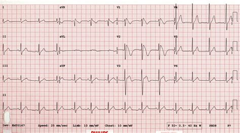 12 Lead Ecg For Children And Adults Sujyotheartclinic