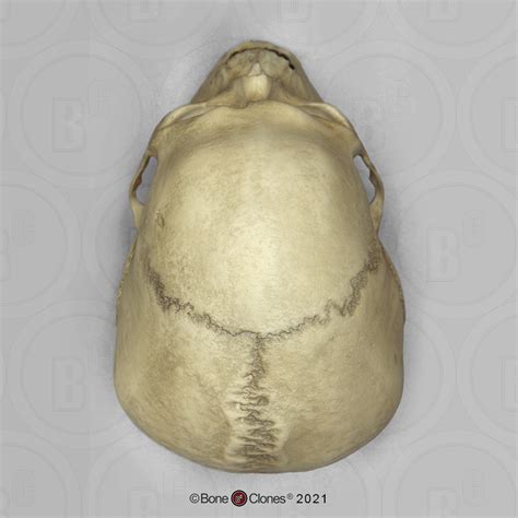 Human Male Skull With A 32 Caliber Gunshot Wound Bone Clones Inc