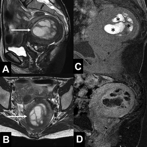 Pelvic Mri In A 48 Year Old Woman With Cystic Adenomyosis A B Download Scientific Diagram