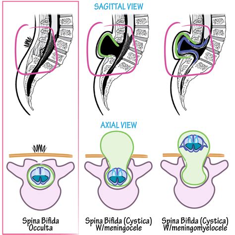 Neuroanatomy Glossary Spina Bifida Occulta Draw It To Know It