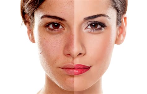 How To Remove Dark Spots On Your Face Best In Health Care Like