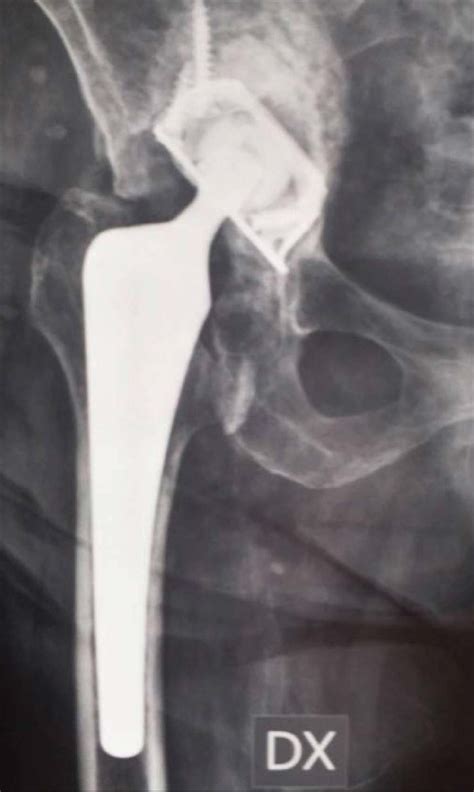 Anteroposterior View Of Infected Right Total Hip Arthroplasty
