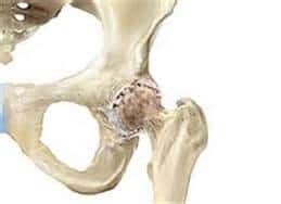 Avascular Necrosis Osteonecrosis Of The Knee Treated With Stem Cell