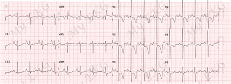 Right Ventricular Hypertrophy In The Electrocardiogram